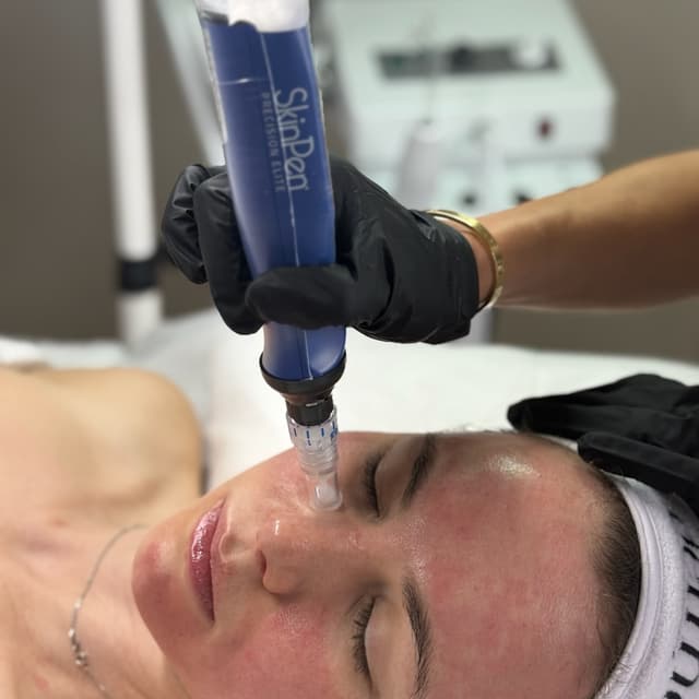 Pack of 3 SkinPen (Microneedling) at DermAdi Skin in Houston, TX